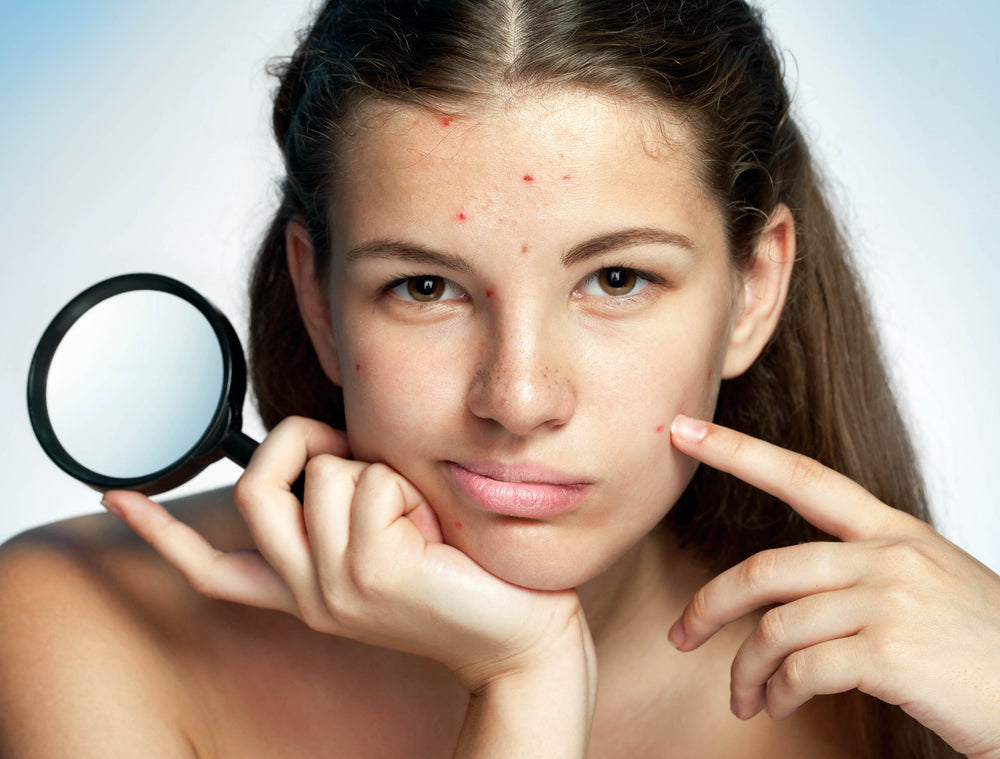 What Exactly IS Acne? Why It Happens and What to Do About It